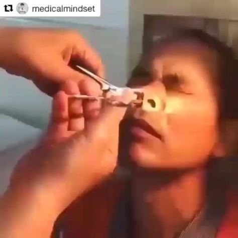 DO IT YOURSELF 𝙀𝙋𝙄𝘾 on Instagram: "Watch till end...😳😳 can you watch this type of satisfying video all day..😍😍 Follow @pimple__pop . . Dm us for credits or post removel. All credits goes to respacted creaters. #pimplepoppervids #pimple #pimples #whitehead #whiteheads #blackhead #blackheads #cyst #pimple #pimples #acne #whitehead #blackhead #blackheads #whiteheads #botfly #drpimplepopper #zit #blackheadremoval #pimplepopping #pimplepopper #pimplesolution #blackheads #whitehead #reels #rep Dr Pimple Poppìng Videos, Pore Cleaning Videos, Cysts Popping Videos, Zit Popping Video Faces, Big Zits, Nose Pimples, Satisfying Zit Popping Videos, Bot Fly, Squeezing Blackheads