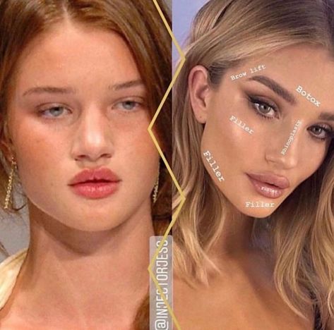 Face Plastic Surgery, Rhinoplasty Nose Jobs, Face Fillers, Rosie Hw, Cheek Fillers, Facial Fillers, Facial Contouring, Cosmetic Dermatology, Facial Aesthetics