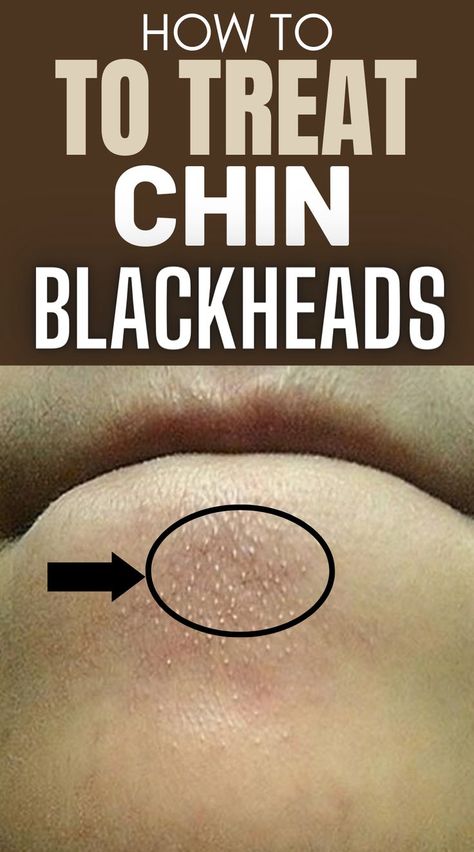 How to Quickly and Easily Remove Blackheads from Your Chin at Home Blackheads On Face, Blind Pimple, Blackheads On Nose, Face Pores, Remove Blackheads, How To Get Rid Of Pimples, Get Rid Of Blackheads, Unwanted Hair Removal, Skin Care Solutions