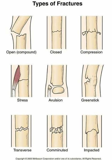 Vet Nursing, Types Of Fractures, Nursing Things, Vet Nurse, Surgical Technologist, Medical Student Study, Nursing School Survival, Nursing School Studying, Medical Facts