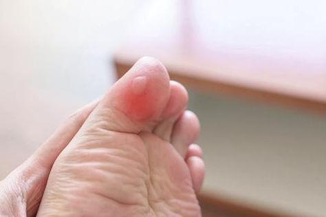 How To Heal Blisters, Moisture Wicking Socks, Warm Compress, Clogged Arteries, Laser Surgery, Prevent Blisters, Crepey Skin, Facial Exercises, Cleveland Clinic