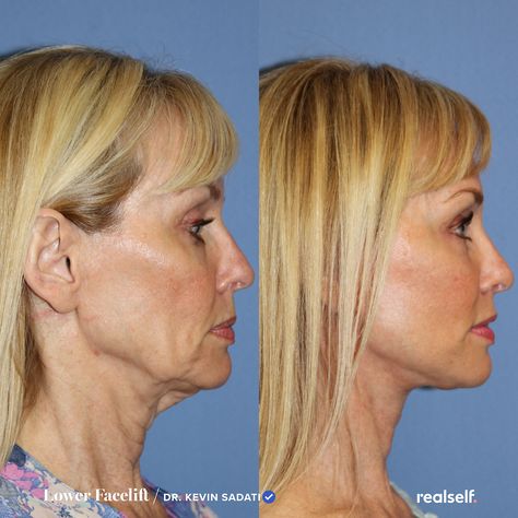 Facelift Recovery, Mid Face Lift, Lower Face Lift, Face Plastic Surgery, Neck Lift Surgery, Facelift Without Surgery, Mini Face Lift, Facelift Before And After, Facelift Procedure