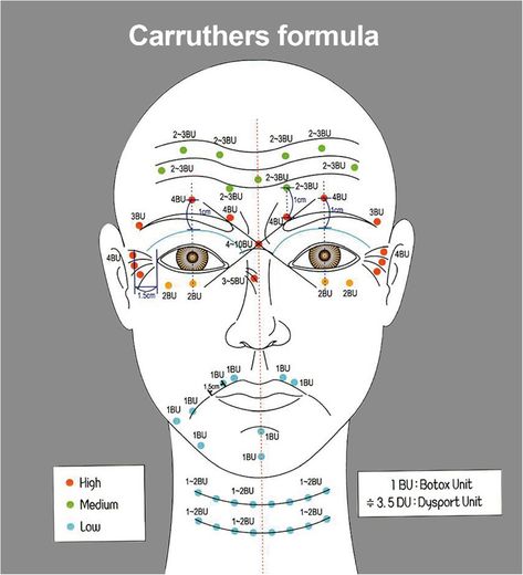 Face Diagram, Botox Injection Sites, Botox Training, Facial Injections, Botox Injection, Botox Lips, Aesthetic Dermatology, Facial Anatomy, Botox Cosmetic