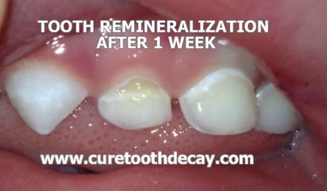 week 1_mini Cavity Remedy, Tooth Pain Relief, Remineralize Teeth, Cavities In Kids, Diy Toothpaste, Baby Tooth Decay, Tooth Decay Remedies, Homemade Toothpaste, Heal Cavities