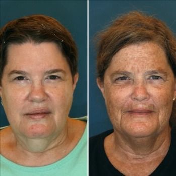 This is not a Before & After. It's a pic of twins from a study. The pictures prove that your daily habits can age you or help you appear more youthful. Sunscreen is your BEST Defense against UVA (aging) rays of the sun. The twin on the right tans and smokes which contributes to her aged appearance. 
Using clinically proven skincare, like our Reverse regimen,  can do a lot to minimize sun damage. The next pics which are Before & Afters. 
See my Skin Quiz for a recommendation. Night Beauty Routine, French Beauty Secrets, Celebrity Beauty Secrets, Natural Beauty Remedies, Holistic Health Remedies, Skin Quiz, Beauty Remedies, Best Skin, Aging Process