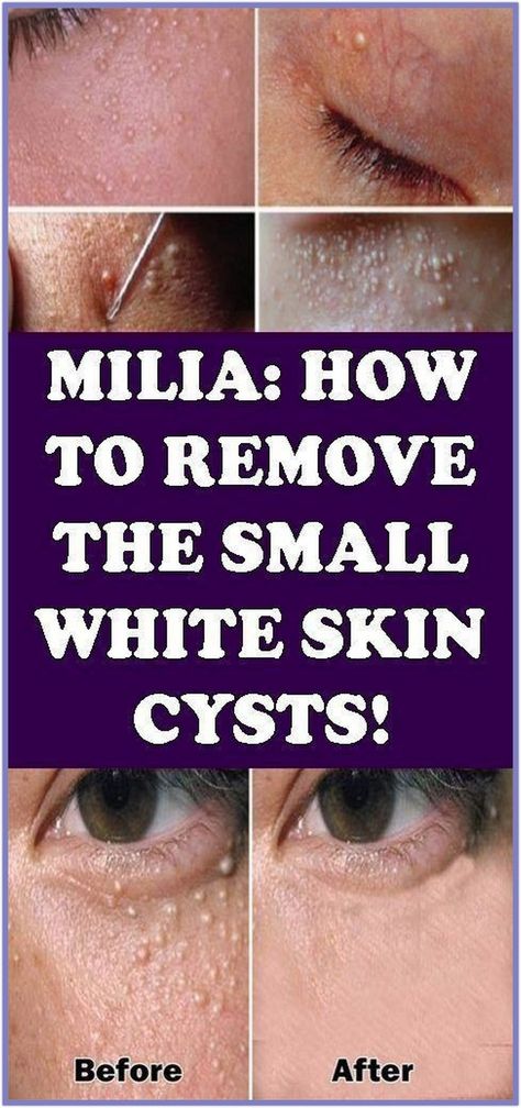 MILIA: HOW TO REMOVE THE SMALL WHITE SKIN CYSTS?"" Milia Removal, Under The Skin, Healthy Lifestyle Habits, Healthy Drinks Recipes, Lifestyle Habits, White Skin, Health Promotion, Fat Burning Drinks, Healthy Skin Care