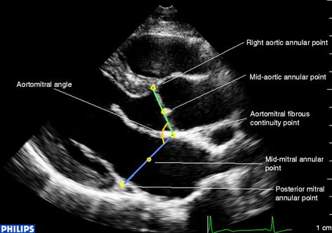 Cardiovascular Anatomy, Echo Ultrasound, Heart Ultrasound, Diagnostic Medical Sonography Student, Ultrasound School, Cardiac Sonography, Sonography Student, Ultrasound Sonography, Medical Ultrasound