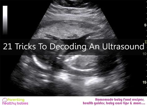 Becoming pregnant, that too for the first time, is definitely a wonderful feeling. Here are 21 Tricks To Decoding An Ultrasound. Boy Ultrasound Pictures, Boy Ultrasound, 16 Weeks Pregnant Ultrasound, Baby Ultrasound, Wipe Warmer, Ultrasound Pictures, Baby Sleep Problems, Pregnant Mom, Healthy Babies