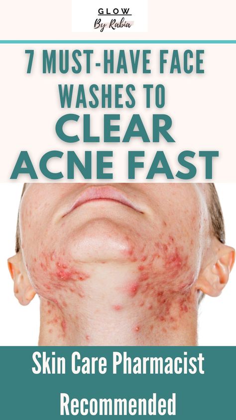 Best Acne Face Wash, Best Skincare Products For Acne, Face Wash Products, Best Face Wash For Acne, Best Products For Acne, Skincare Products For Acne, Clear Acne Fast, Face Wash For Acne, Science Tips