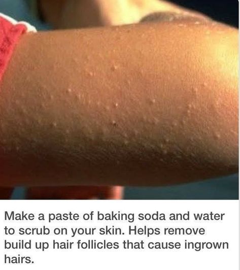 Obličejové Masky, Clear Skin Tips, Beauty Remedies, Diy Beauty Hacks, Skin Care Solutions, Diy Skin, Ingrown Hair, Diy Skin Care, Healthy Skin Care