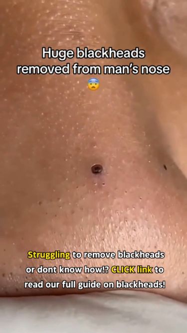 Experience Skincare Bliss: Satisfying Blackhead Removal Videos Blackheads Removal Video Black Heads, Satisfying Black Head Removal Video, Blackheads Removal Cream, How To Remove Blackheads, Blackhead Remover Diy, Blackhead Extraction, Black Head Remover Mask, To Remove Blackheads, Eye Wrinkles