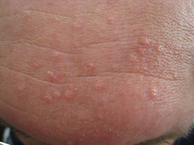 This is sebaceous hyperplasia - enlarged sebaceous glands common on forehead. It appears as small yellow bumps up to 3 mm in diameter with a central hair follicle surrounded by yellowish lobules. It can be treated with products such as ZO's Exfoliation Accelerator/ retinol based serums and/ or Thermocoagulation. Bumps On Forehead, Sebaceous Hyperplasia, Forehead Bumps, Thread Veins, Skin Lesions, Skincare Advice, Hydra Facial, Skin Care Range, Skin Clinic