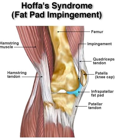 Infra-patellar Fat Pad Syndrome (Hoffa's Syndrome) | Physica Knee Fat, Knee Pain Remedy, Swollen Knee, Knee Pain Exercises, Nerve Health, Knee Exercises, Knee Pain Relief, Joints Pain Relief, Knee Injury