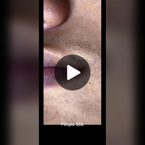 #blackhead #pimple366 #satisfying #pimplestreatment #pimple | Satisfying Video | TikTok Pimple Extraction, Video Tiktok, Satisfying Video, Blackheads