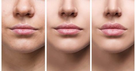 Lip Flip Vs. Lip Filler – Know the Difference Lip Flip, Lip Types, Hyaluronic Acid Fillers, Kylie Jenner Lips, Lip Augmentation, Injectables Fillers, Lip Enhancement, Lip Serum, Aesthetic Clinic