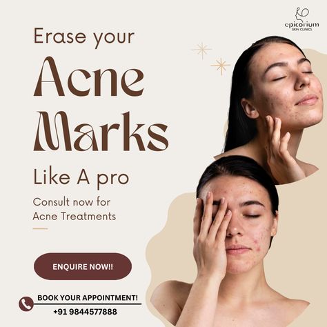 Insta Ads, Natural Wrinkle Remedies, Treatments For Acne, Permanent Makeup Studio, Skin Quotes, Stubborn Acne, Skin Facts, Wrinkle Remedies, Skin Therapist