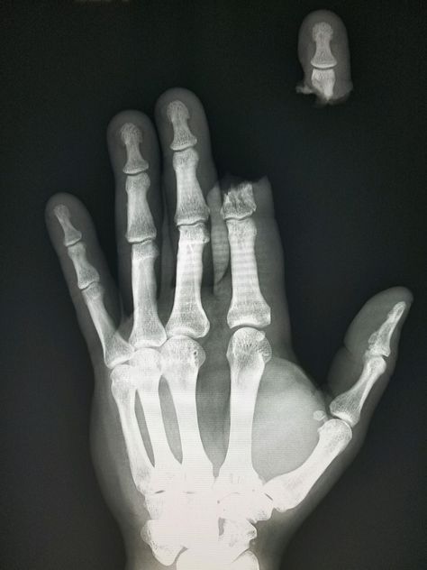 #Hand #Xray shows severed #finger in a #chainsaw #accident.  #radiology #radiologist #pain #injury #trauma #powertool Hand Xray, Severed Finger, Finger Injury, Vegetarian Fast Food, Radiology, X Ray, Chainsaw, Rats, Abc