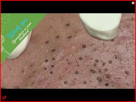 💃 Perfect Skin – The Comprehensive Solution for All Your Needs! zits popping, squeezing pimples, blackheads popping videos faces #blackheadsremoval #glowingskin #zit Popping Blackheads Youtube Videos, Blackheads Removal Cream, Nose Pimples, Squeezing Blackheads, Pimple Extraction, Blackheads On Face, Cystic Pimple, Zit Popping Videos, Zits Popping