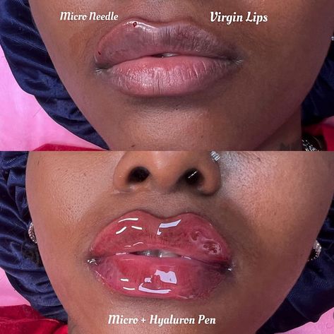 NO FILTER JUST FILLER 😍 APPOINTMENTS & TRAININGS available for lip filler services 😍 100% Hyaluronic Acid No Pain | No Downtime Natural Alternative Lasts 12 + Months With Proper Care 20-30 Min Procedure Filler Black Women, Lip Filler Business, Lip Filler, Face Exercises, Lip Fillers, No Filter, Beauty Bar, Body Works, Bath And Body Works