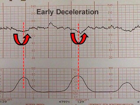 Decelerations Nursing, Fetal Monitoring Nursing, Fetal Heart Monitoring, Obstetrics Nursing, Baby Heart Rate, Cranial Nerves Mnemonic, Fetal Monitoring, Fetal Heart Rate, Labor Delivery Nursing