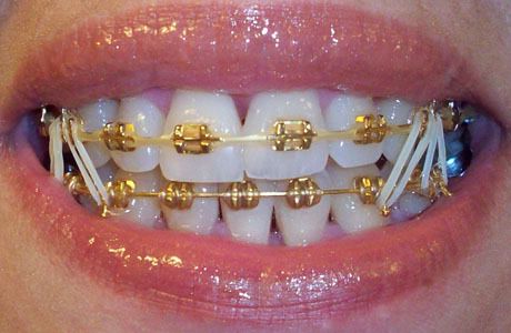 I wish I would have gotten these. Str8 thugin! Smile With Braces, Bijoux Piercing Septum, Gold Braces, Natural Teeth Whitening Diy, Cute Braces Colors, Braces Tips, Getting Braces, Braces Girls, Health Aesthetic