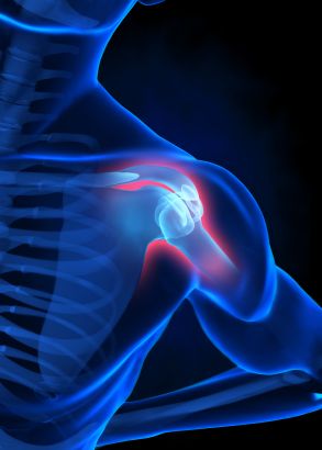 Subacromial Impingement Syndrome: Posterior Capsule Tightness and the “Diablo Effect” Rotator Cuff Exercises, Shoulder Dislocation, Shoulder Problem, Shoulder Impingement, Shoulder Injury, Dysfunctional Relationships, Shoulder Surgery, Shoulder Injuries, Orthopedic Surgery