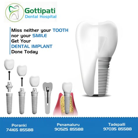 Get Your DENTAL IMPLANT Done Today For More Details Visit Our Gottipati Dental Hospital In Vijayawada #Dentalhospitalinvijayawada #Braces #Metalcrowns #Teethwhitening #Implants #Rootcanals Dental Implants Creative Ads, Medical Ads, Dental Design Interior, Dental Hospital, Dental Design, Dental Implant, Creative Ads, Dental Implants, Dental Care