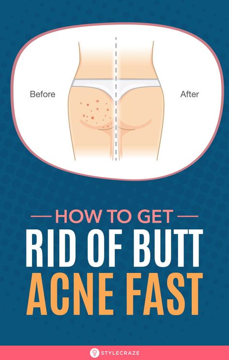 How To Get Rid Of Butt Acne Fast: When you were about to try out that gorgeous two-piece, all your excitement turns into instant horror when you see a group of red and angry looking butt acne stare right back at you. We have listed some of the best home remedies that can help you combat butt acne – and also your worries! #Beauty #BeautyTips #Remedies #ButtAcne #Acne #Pimples How To Get Rid Of Popped Pimples Fast, How To Get Rid Of Acne On Buttocks, How To Get Rid Of Body Acne Products, How To Get Rid Of Buttocks Acne At Home, Get Rid Of Back Acne Fast, Body Acne How To Get Rid Of, Beauty Hacks That Actually Work, Beauty Tips And Tricks, Acne Facial