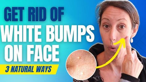 White Bumps On Face, Bumps On Face, Milia Removal, Small Bumps On Face, Forehead Bumps, Dairy Free Breastfeeding, Healthy Living Motivation, Dark Underarms, Spots On Face