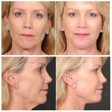 The Ponytail Lift™: Not Your Average Facelift - Los Angeles, CA | Kao Plastic Surgery Ponytail Facelift, Ponytail Lift, Plastic Surgery, Surgery, Anti Aging, Angeles, Beauty, Los Angeles