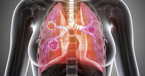 The two major classifications of chronic lung diseases are 1-obstructive and 2-restrictive. Here's what you need to know about restrictive lung disease. Pulmonary Function Test, Chronic Lung Disease, Pleural Effusion, Chronic Cough, Diaphragmatic Breathing, Chronic Obstructive Pulmonary Disease, Disease Symptoms, Holistic Care, Pulmonary Disease