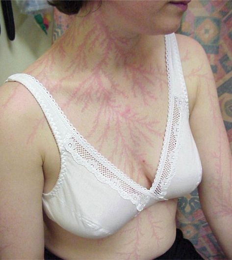 People who are struck by lightning are sometimes left with tattoo-like markings called Lichtenberg figures, or lightning flowers. The patterns created are known to be examples of fractals. Anders Dragon Age, Lightning Scar, The Babadook, Lichtenberg Figures, Struck By Lightning, Photographie Portrait Inspiration, Fractal Patterns, Lightning Strikes, S Tattoo