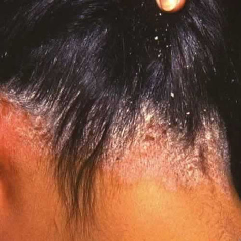 scalp-psoriasis_0 Dry Patches On Scalp, Sebhorric Dermitis Scalp, Sebboric Dermitis Scalp, Flaky Scalp Remedy, Dandruff Remedy Severe, Scalp Scaling, Itchy Scalp Remedy, Sores On Scalp, How To Grow Hair Faster