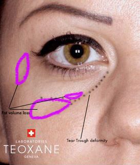 Diagram of tear trough deformity and how to get rid of dark under eye circles post. How To Get Rid Of Tear Troughs, Botox Funny, Face Injections, Dermal Fillers Lips, Dark Under Eye Circles, Pdo Threads, Under Eye Primer, Medical Aesthetician, Botox Filler