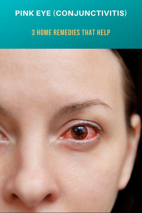 Home Remedy For Eye Infection, Pink Eye Relief, Pink Eye Remedies, Pink Eye Remedy, Itching Remedies, Pinkeye Remedies, Hygiene Activities, Pink Eye, Social Media Calendar