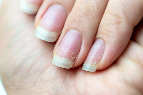 Cracked Nails, Nails Today, Damaged Nails, Nail Pictures, Brittle Nails, Nail Growth, What To Use, Dry Nails, Strong Nails