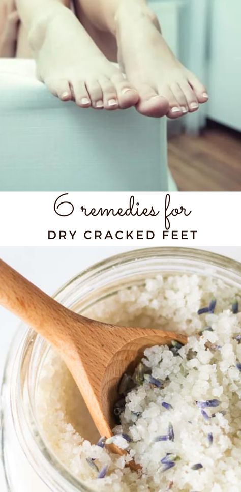 The best way to remove dry, cracked skin on feet naturally with these simple tips and tricks. Dry Cracked Feet Remedy Diy, Dry Cracked Feet Remedy, Cracked Feet Remedies, Natural Face Wash, Homemade Bath, Scaly Skin, Homemade Soap Recipes, Sugary Food, Natural Skin Care Routine