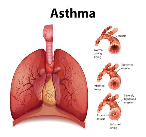 Free vector comparison of healthy lung a... | Free Vector #Freepik #freevector #lungs #lung-disease #asthma #anatomy Throbbing Headache, How To Help Nausea, Severe Asthma, Healthy Lungs, Chronic Obstructive Pulmonary Disease, Asthma Symptoms, Healthy Morning Routine, Pulmonary Disease, Respiratory Diseases