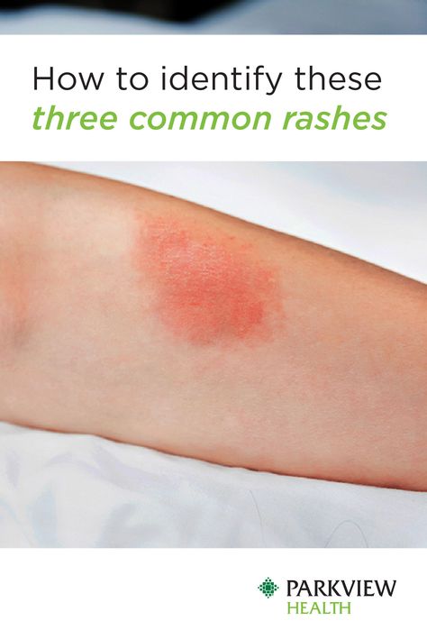 Red Rashes On Skin, Skin Rashes Pictures, Common Skin Rashes, Leg Rash, Itchy Skin Rash, Body Rash, Rash On Neck, Red Rash, Itchy Rash