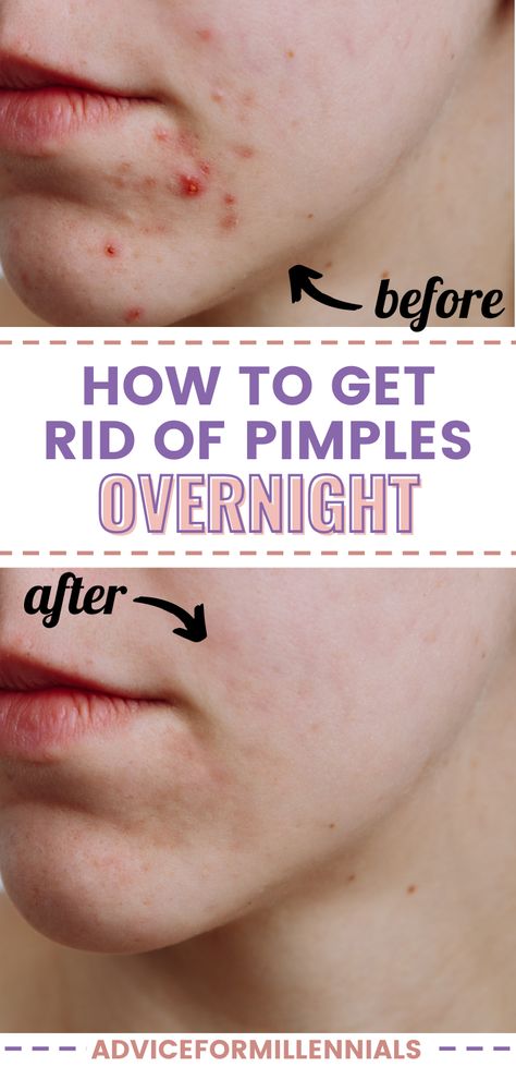 How to get rid of pimples overnight Overnight Pimple Remedies, Pimple Remedies, Zit Remedy, Get Rid Of Pimples Overnight, Rid Of Pimples Overnight, Huge Pimple, Dry Out Pimples, Big Pimple, Back Acne Remedies