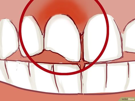 How To Fix A Chipped Tooth, Chipped Tooth Repair Diy, Chipped Tooth Repair, Smile Tips, Tooth Pain Relief, Dental Animation, Rotten Teeth, Broken Teeth, Teeth Remedies