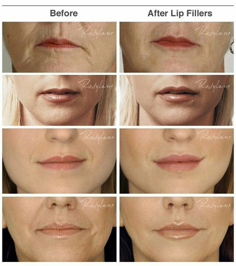 subtle lip aug Lip Injections Juvederm, Dermal Fillers Lips, Juvederm Lips, Face Fillers, Botox Lips, Money Manifest, Aesthetic Dermatology, Lip Art Makeup, Best Lip Gloss