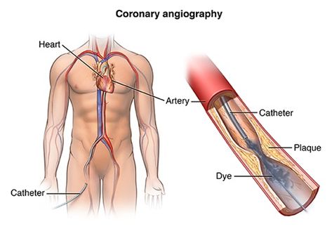 Heart Catheterization, Heart Arteries, Enlarged Heart, Heart Valves, Medical Business, Heart Care, Congenital Heart, Heart Muscle, Coronary Arteries