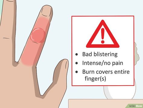 How To Treat A Burn Skin, Burn Blister, How To Treat Blisters, Curling Iron Burn, Water Blister, Blister Remedies, 2nd Degree Burns, Burned Finger, Burn Remedy