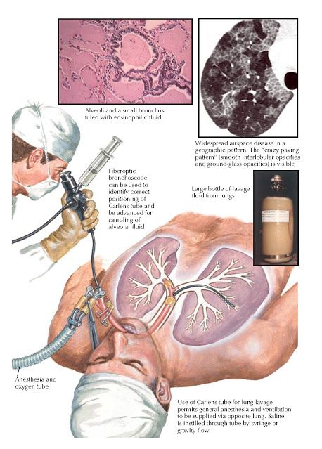 Body Knowledge, Hypersensitivity Reactions, Medical Dictionary, Crazy Paving, General Anaesthesia, Pulmonology, Biomedical Science, Lip Care Routine, Medical School Essentials