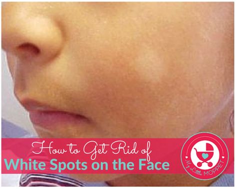 White patches on your child's face can be scary, but it's probably Pityriasis Alba. Read on to know more about how to get rid of white spots on the face. Pityriasis Alba, White Spots On Skin, White Skin Patches, White Skin Spots, Vitamin Foods, Spots On Skin, Tea Tree Oil Face, Blind Pimple, Forehead Acne