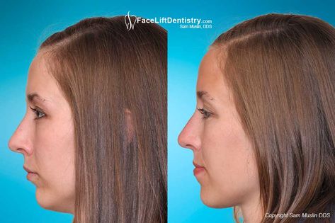 Correct a small chin, misaligned jaw and overbite, and enhance the shape of the face without chin augmentation surgery or braces with no downtime. Small Chin Hairstyles, No Chin Faces, Receding Jawline, Small Jawline Faces, Receding Chin Hairstyles, Chin Enhancement Before After, Receding Chin, Small Jawline, Weak Chin Profile