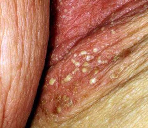 Yeast Infection on Your Skin (Cutaneous Candidiasis) Home Remedy For Yeast Infection In Women, Yeast Infection Remedies Fast At Home, How To Get Rid Of Yeast Infection Fast, Bath For Yeast Infection, Yeast Infection Remedies Fast, Home Remedies For Yeast Infection, White Skin Spots, Yeast Infection On Skin, Treat Yeast Infection