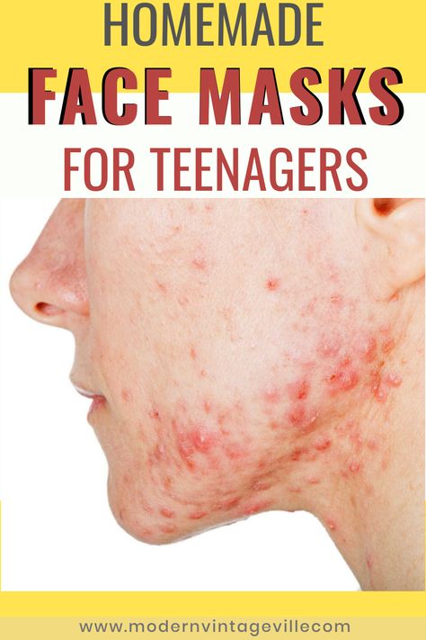 9 DIY Face Masks for Teenagers Diy Acne Mask Homemade, Face Mask For Acne And Pimples, Diy Peel Off Mask, Pimple Mask, Face Mask For Pimples, Pimple Solution, Pimple Free Skin, Teenage Acne, How To Clear Pimples