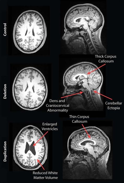 Mri Brain, Radiology Student, Corpus Callosum, Radiology Imaging, Brain Surgeon, Brain Images, Medical Wallpaper, Brain Anatomy, White Matter